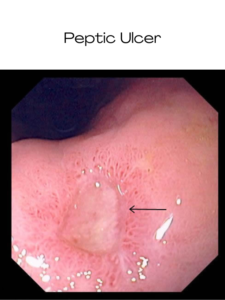 Peptic Ulcer